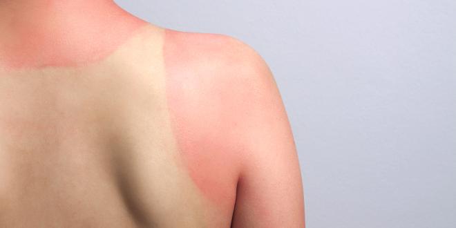 a shirtless person with a terrible sunburn