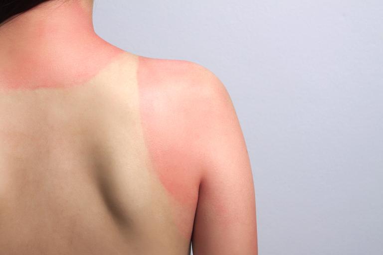 a shirtless person with a terrible sunburn